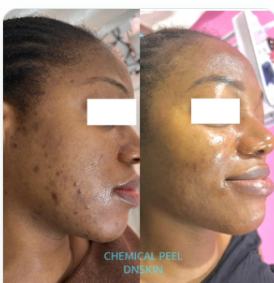 Before and after chemical peel, face result, real DNS client, no face shown
