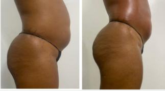 Before and after body result, real DNS client, no face shown