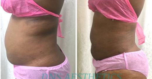 Before and after tummy and waist result, real DNS client, no face shown