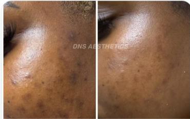 Before and after acne scarring, microneedling result, real DNS client, no face shown