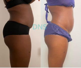 Before and after body result, real DNS client, no face shown