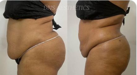Before and after result at DNS Aesthetics, real client, no face shown