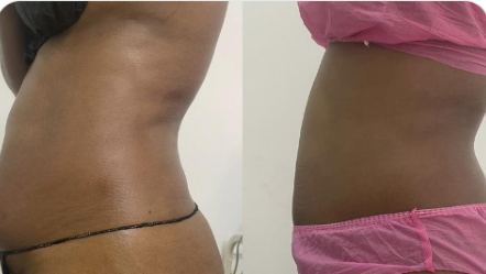Before and after result at DNS Aesthetics, real client, no face shown