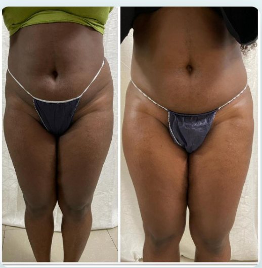 Before and after regenerative treatment result, real DNS client, no face shown