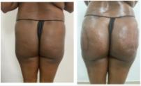 Before and after body contouring result, real DNS client, no face shown