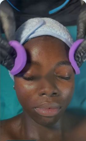 Microneedling at DNS Aesthetics