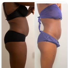 Before and after side profile, regenerative result, real DNS client, no face shown