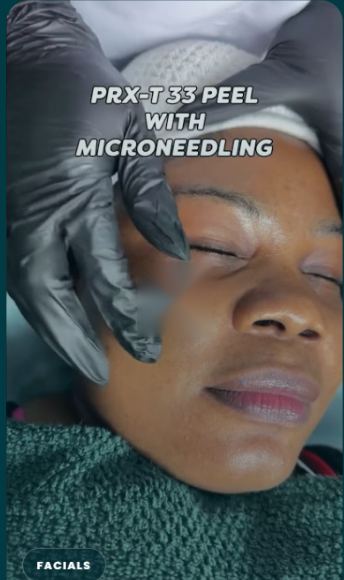 PRX-T33 peel at DNS Aesthetics