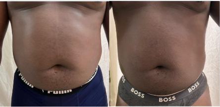 Before and after tummy, front result, real DNS client, no face shown