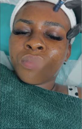 Skin treatment at DNS Aesthetics