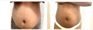 Before and after body contouring result, real DNS client, no face shown