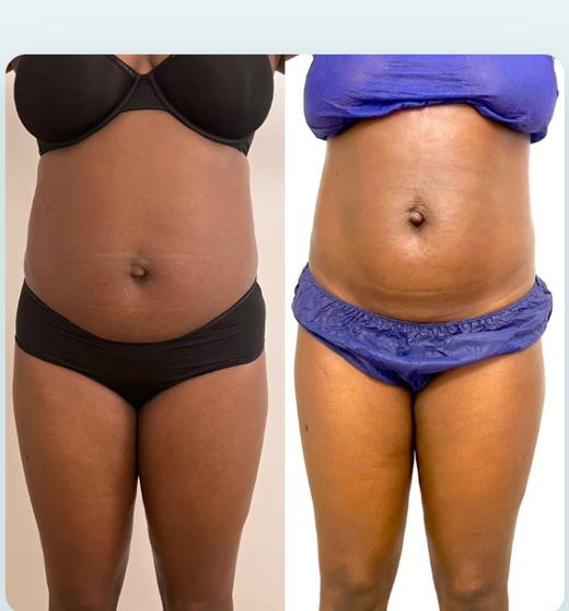 Before and after abdomen and thighs result, real DNS client, no face shown