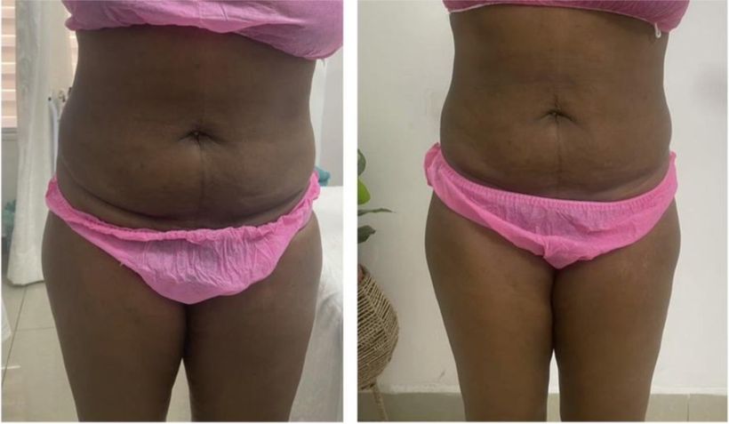 Before and after body contouring result, real DNS client, no face shown