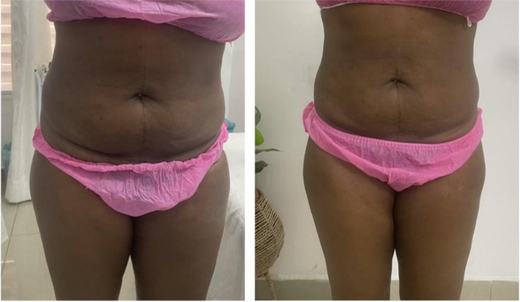 Before and after tummy, side profile result, real DNS client, no face shown