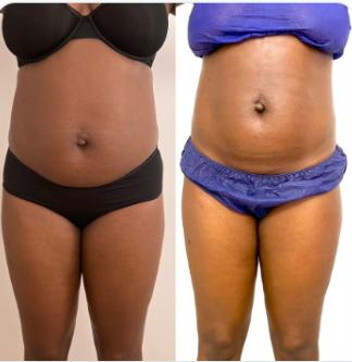 Before and after body result, real DNS client, no face shown