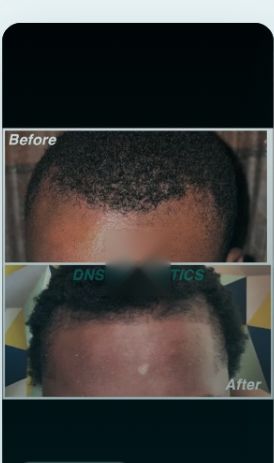 Before and after regenerative treatment result, real DNS client, no face shown