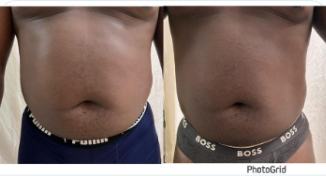 Before and after body contouring result, real DNS client, no face shown