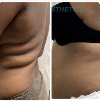 Before and after body contouring result, real DNS client, no face shown