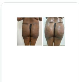 Before and after back of thigh result, real DNS client, no face shown
