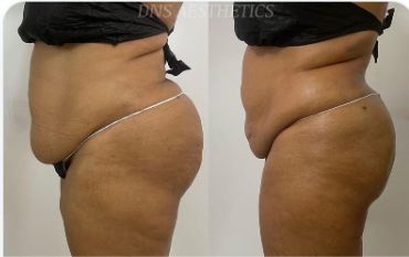 Before and after regenerative treatment result, real DNS client, no face shown