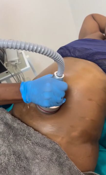 Treatment in progress at DNS Aesthetics, Lekki Phase 1