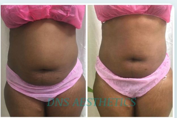 Before and after waist result after three sessions, real DNS client, no face shown