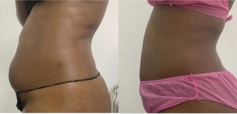 Before and after body contouring result, real DNS client, no face shown