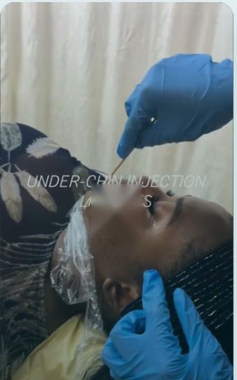 Under-chin lipolysis at DNS Aesthetics