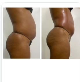 Before and after hip and butt, regenerative result, real DNS client, no face shown