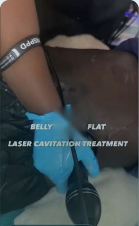 Stretch marks and body at DNS Aesthetics