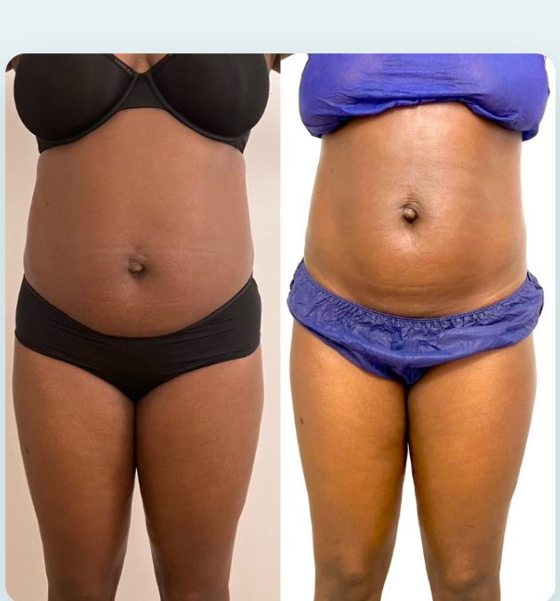 Before and after abdomen result at DNS Aesthetics, real client, no face shown